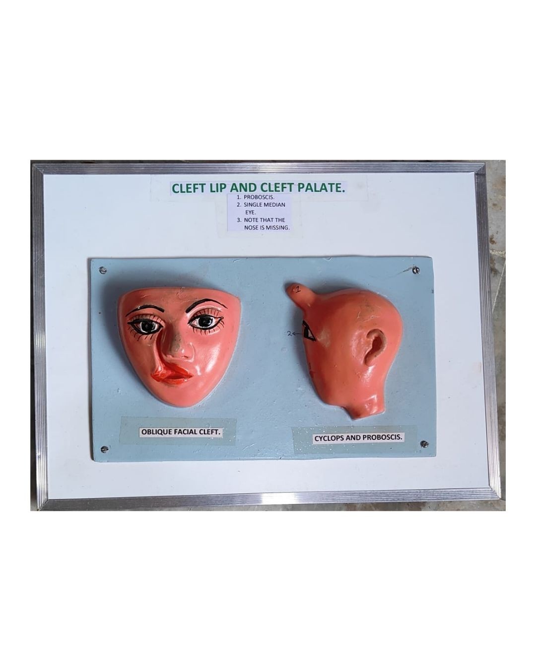 Cleft Lip and Cleft Palate Model