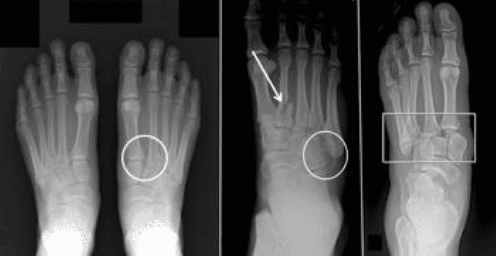 x-ray of Lisfranc Injury Treatment