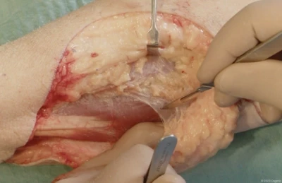 Fasciotomy of the forearm