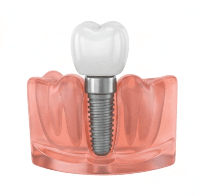 Single dental implant 3D model showing crown placement