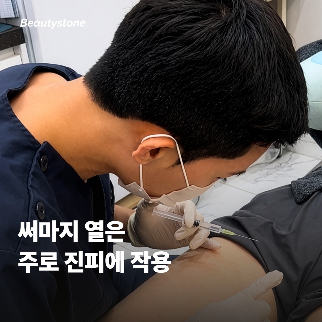 써마지의 열은 실제로 어느 층에 작용할까요