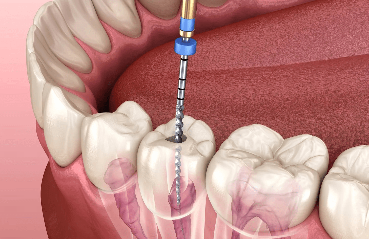 Root Canal Rochelle Park