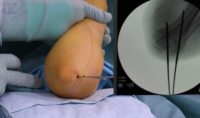 Supracondylar humerus fracture fixation