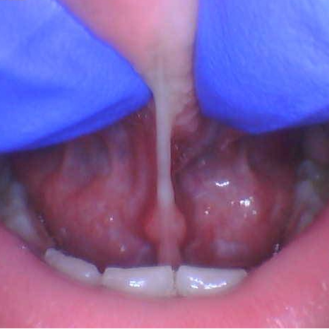     Close-up clinical image of a child or teen’s tongue tie before frenectomy, with gloved hands gently lifting the tongue to show the restricted frenulum.