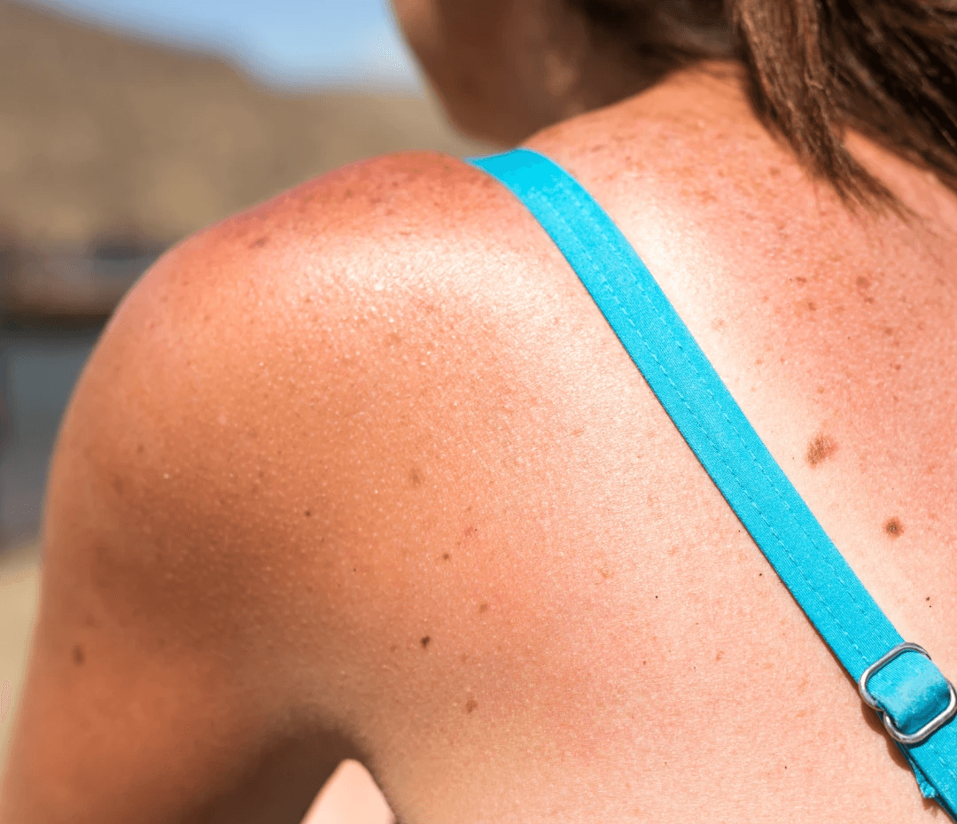 Sunburned skin on woman's shoulder and back