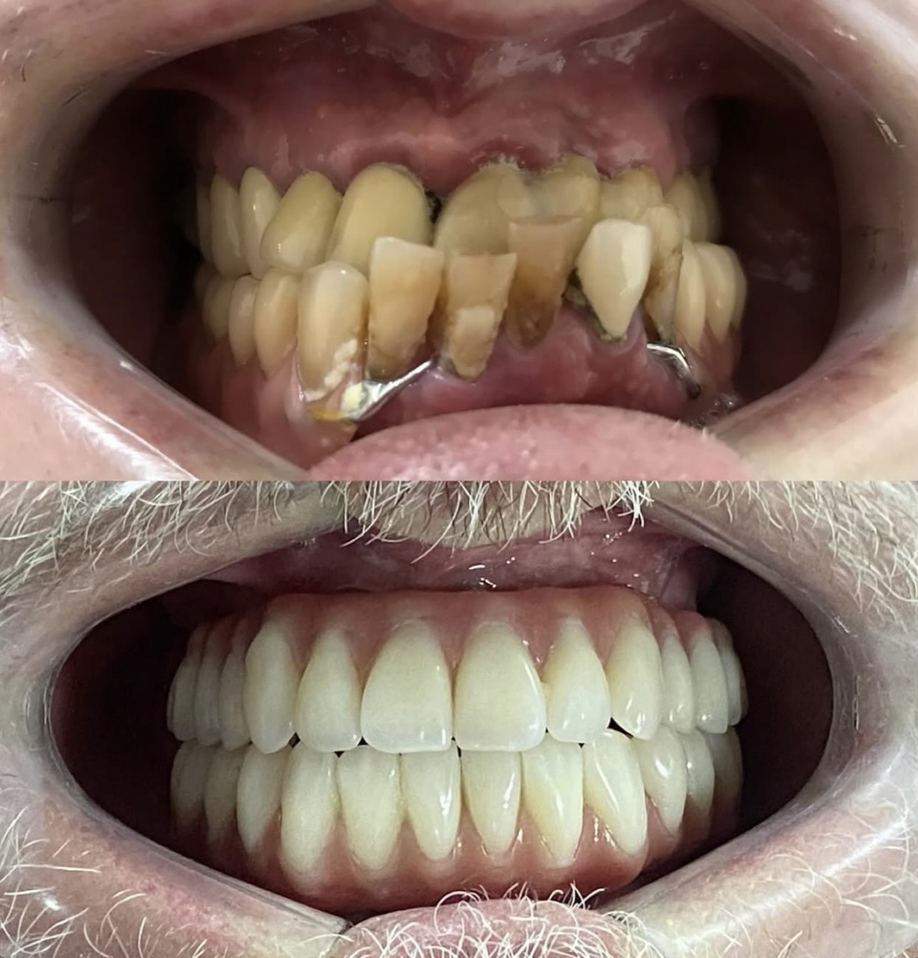 full mouth restoration