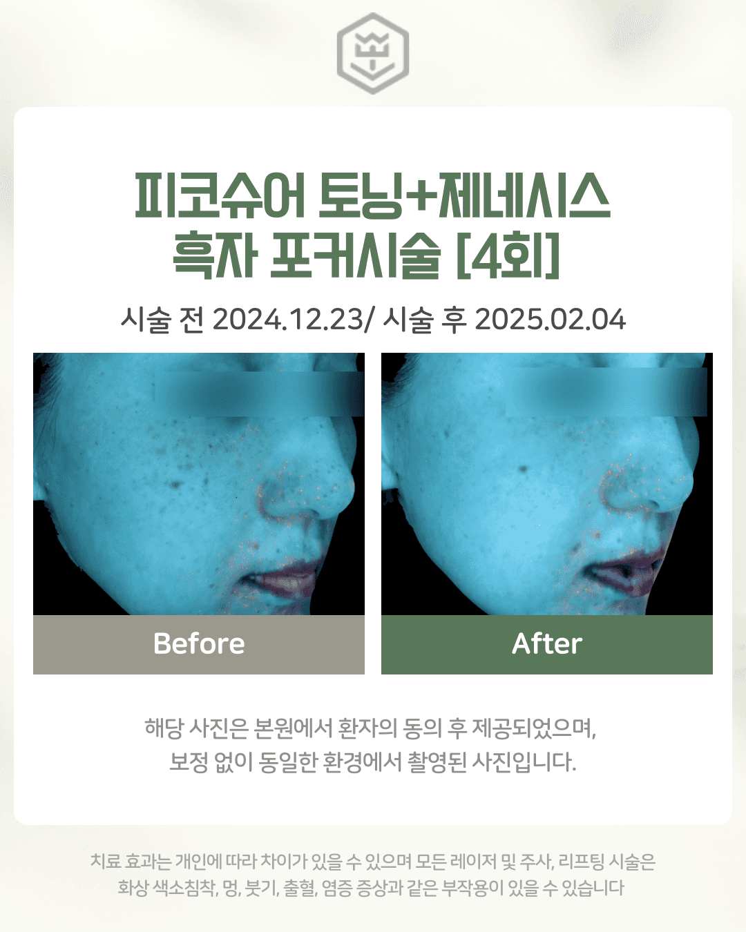 피코슈어+제네시스+흑자포커스 4회