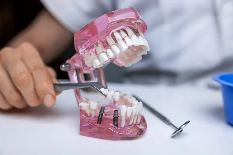 dental implants