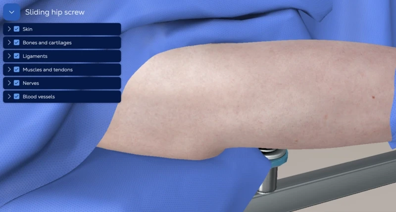 Sliding hip screw (DHS)