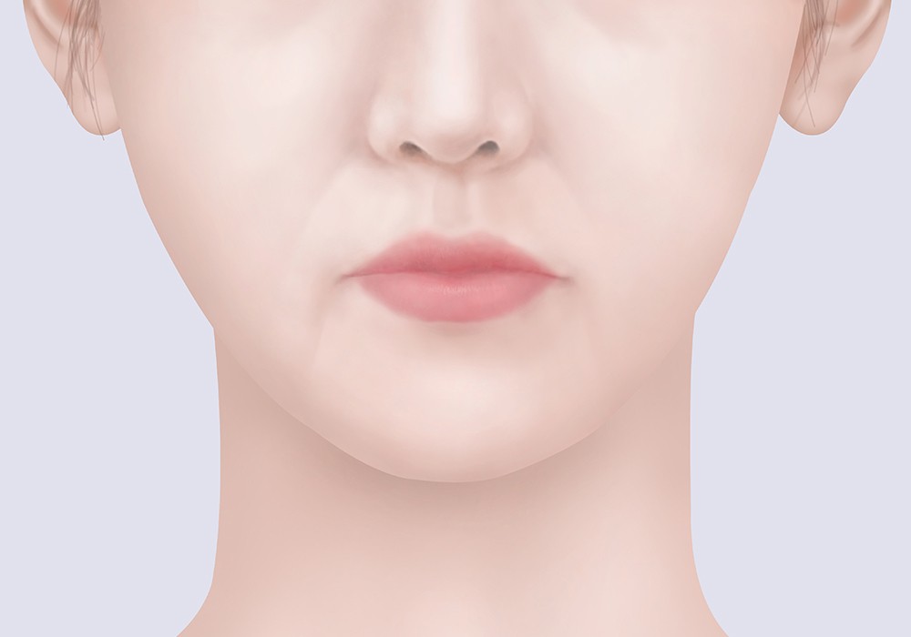loss of facial fat