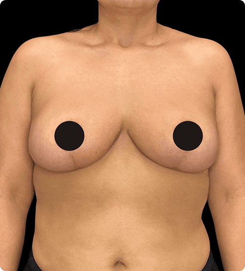 MAMOPLASTIA DE REDUCCIÓN - AFTER