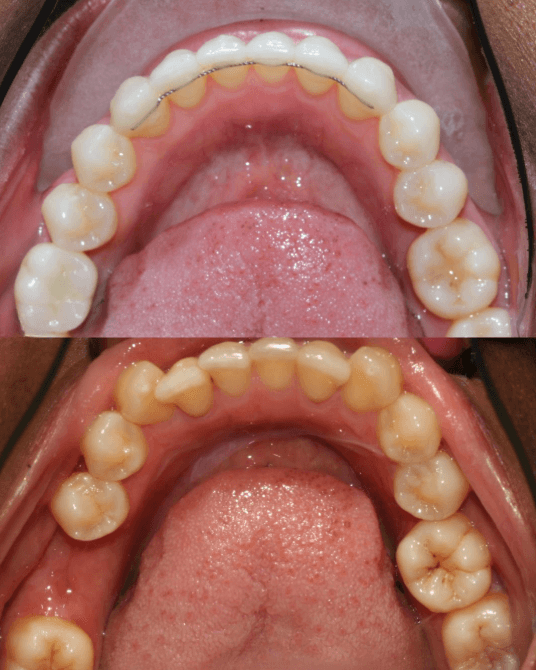 Dental Crown at ScarbroSmiles Before and After at ScarboroSmiles Dental Clinic in Scarborough, ON | Best dentist in Scarborough, ON.