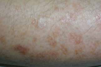 Figure 3: Diffuse superficial actinic porokeratosis