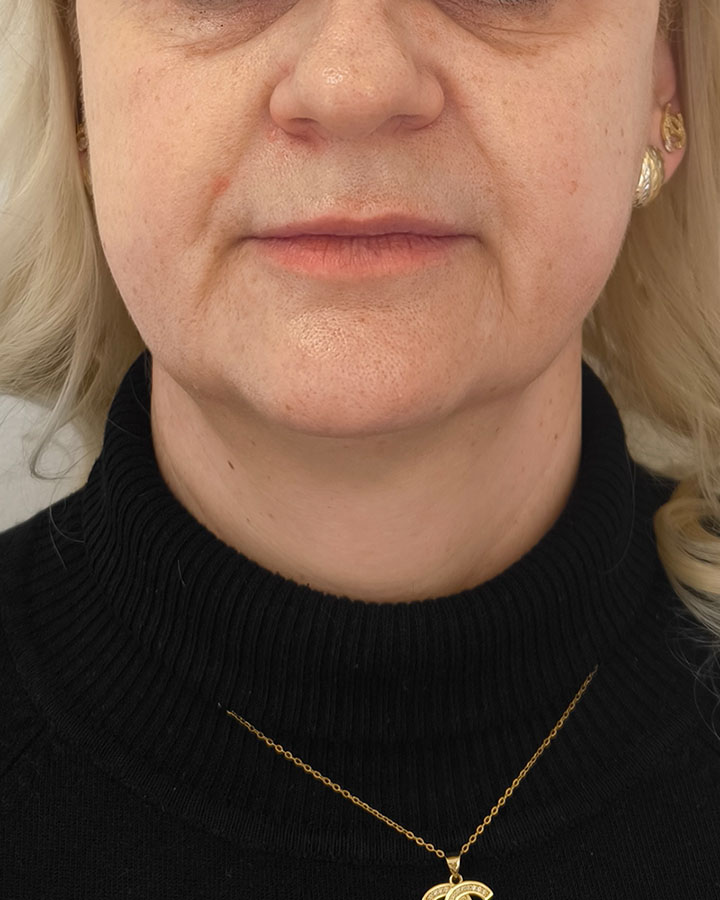 Strata objemu v lícach a výrazné kruhy pod očami pred korekciou