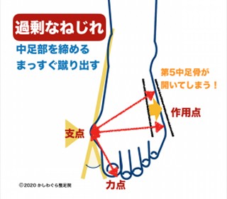 過剰なねじれの図解イメージ