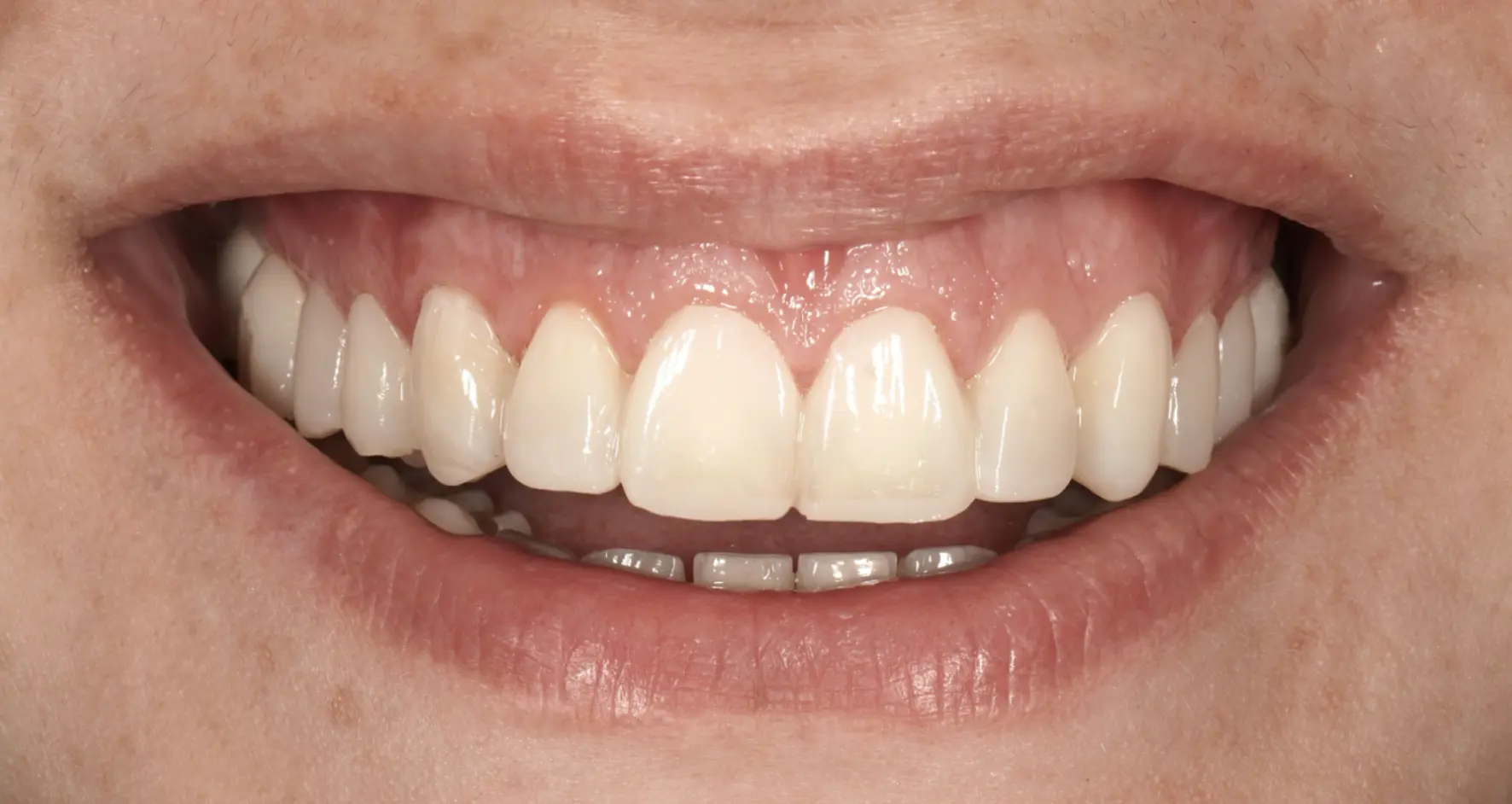 Mock-up of frontal teeth