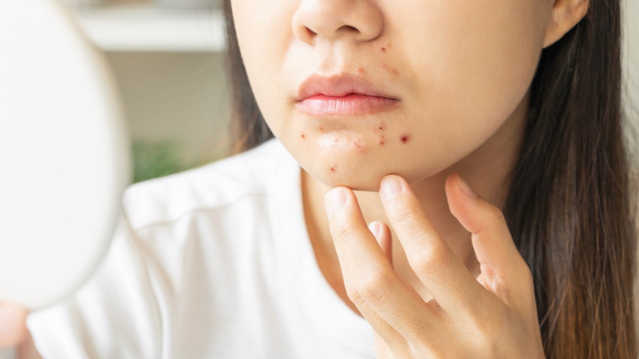 Woman examining acne scars on her chin in a mirror