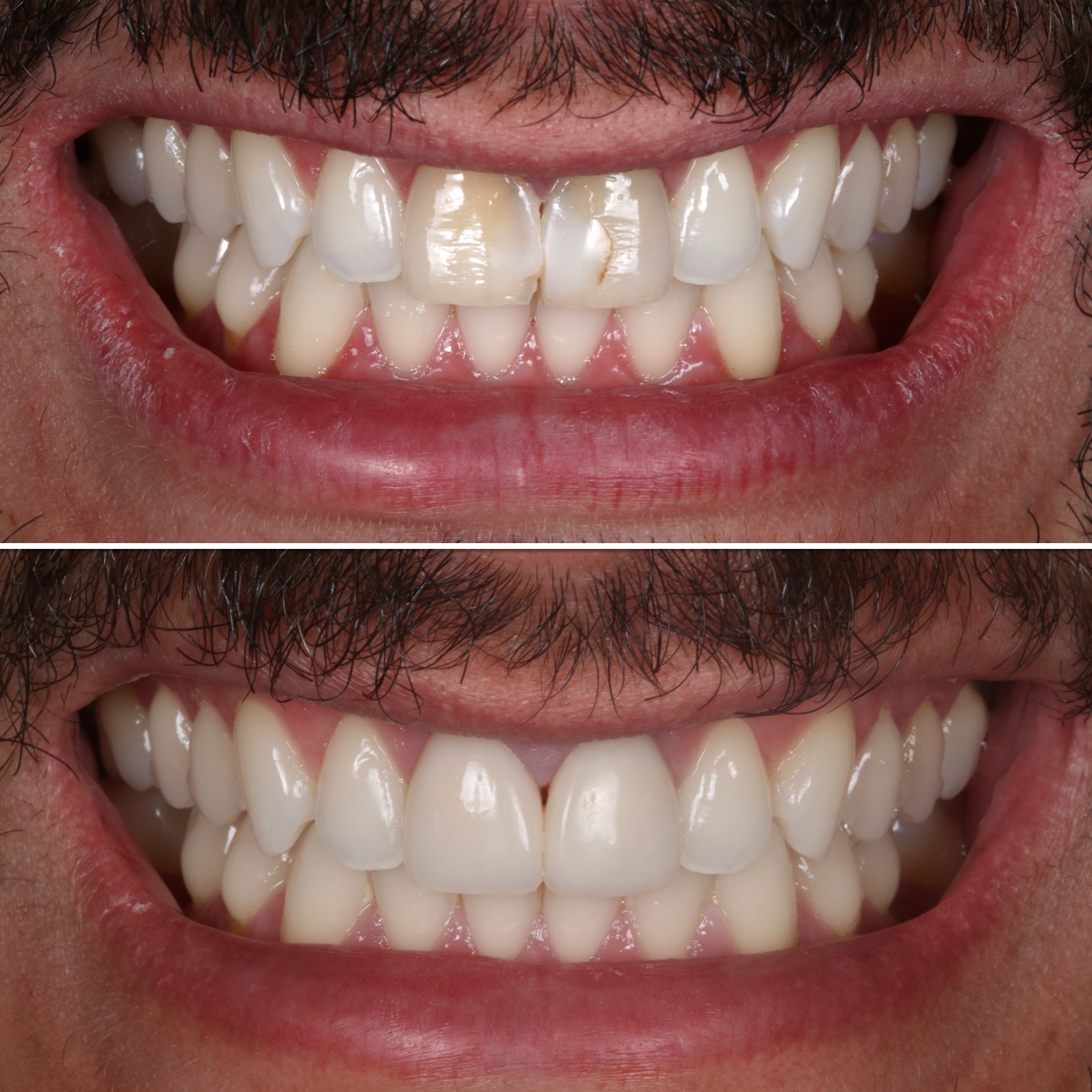 Fotos antes e depois de um sorriso.