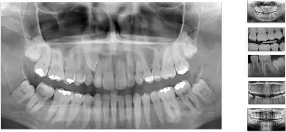 Radiografie dentară panoramică procesată în dROOT, software stomatologic avansat pentru gestionarea imaginilor medicale.