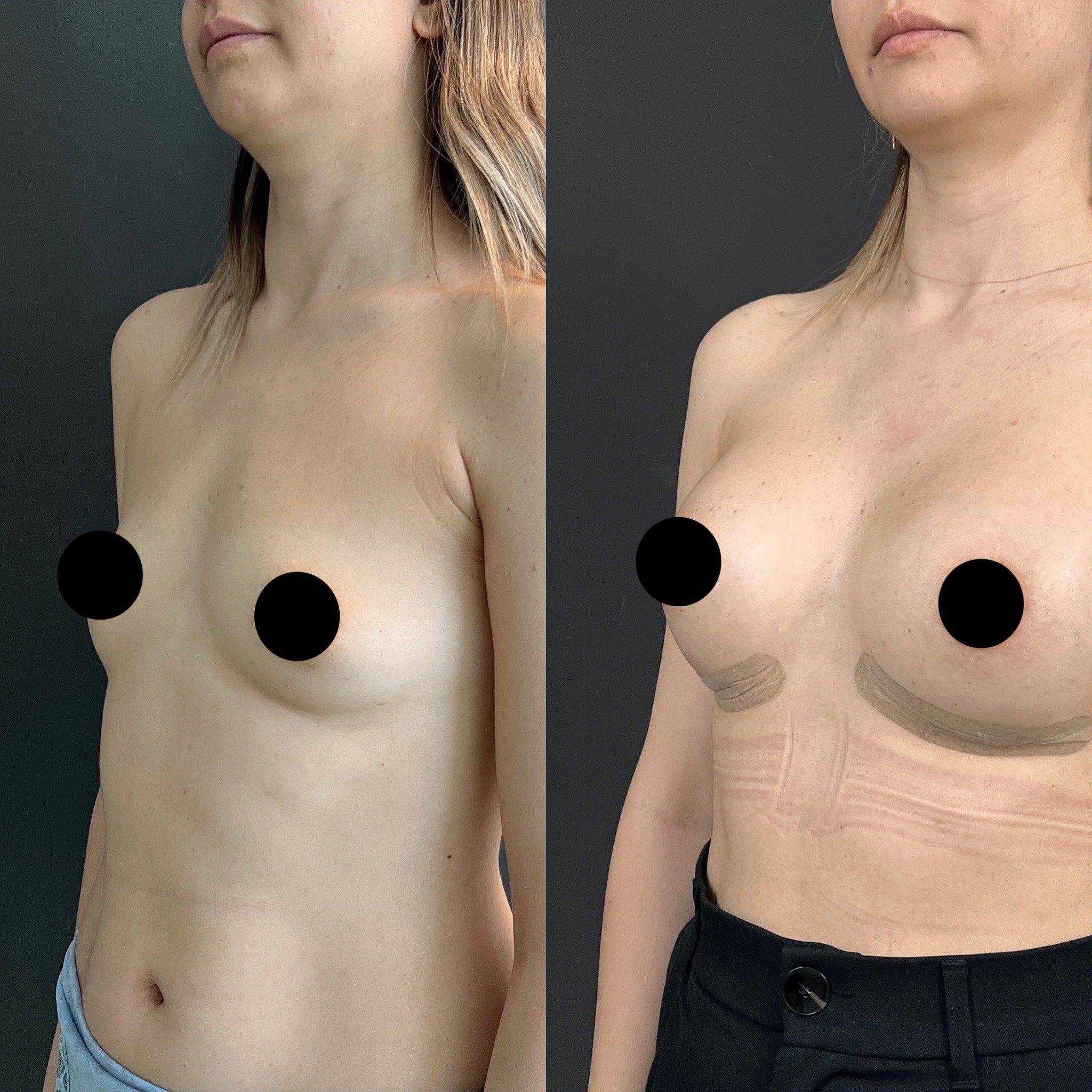 2nd week breast implant before after left oblique view