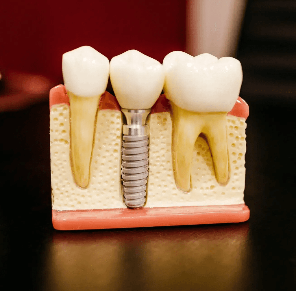 dental implants process