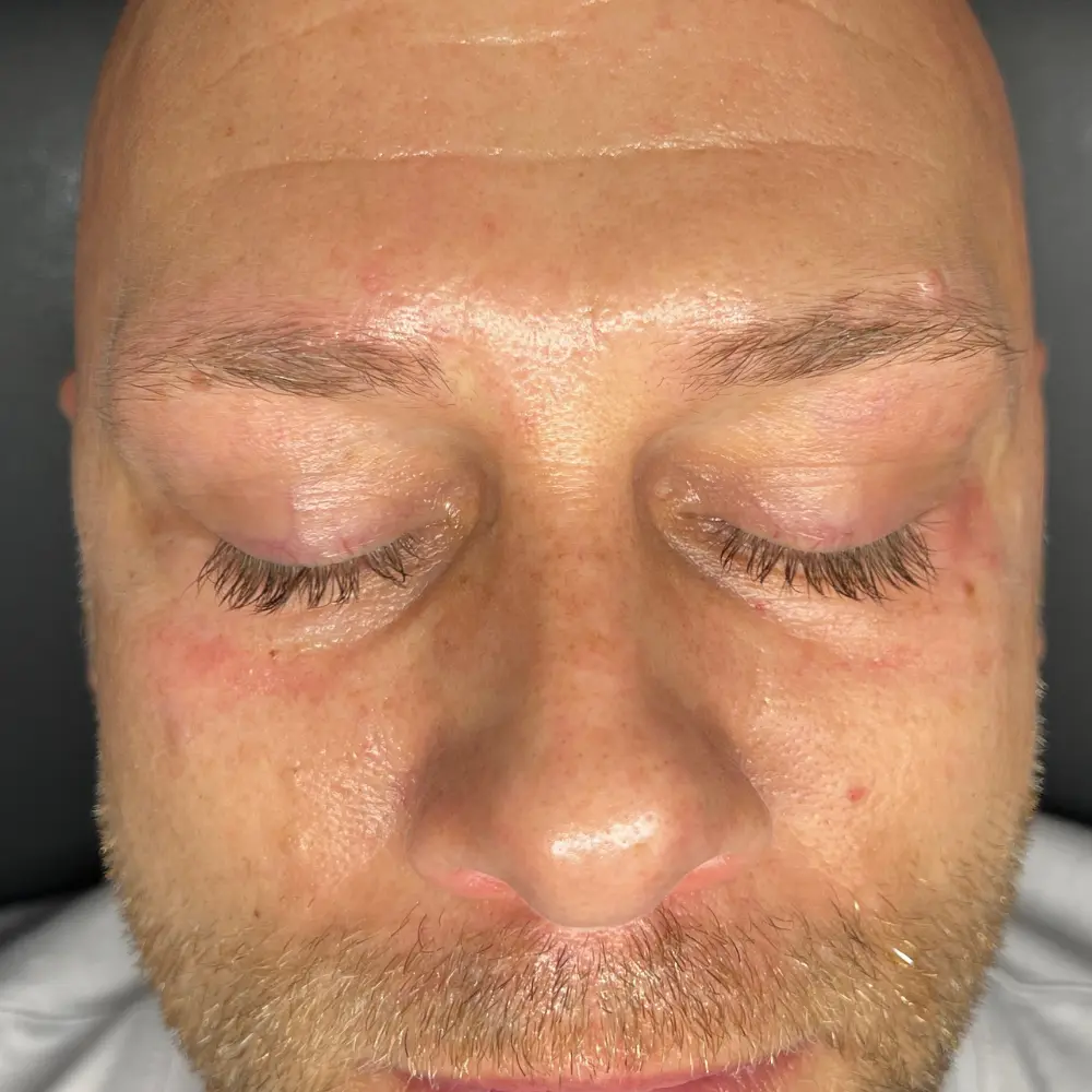 Before men's facial at The Vancouver Aesthetician — professional man with visible under eye wrinkles, dark circles and tired aging skin