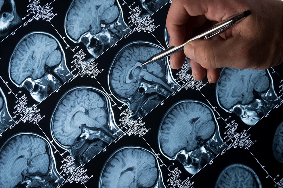 Close-up of brain MRI films with a physician’s hand pointing to areas of concern
