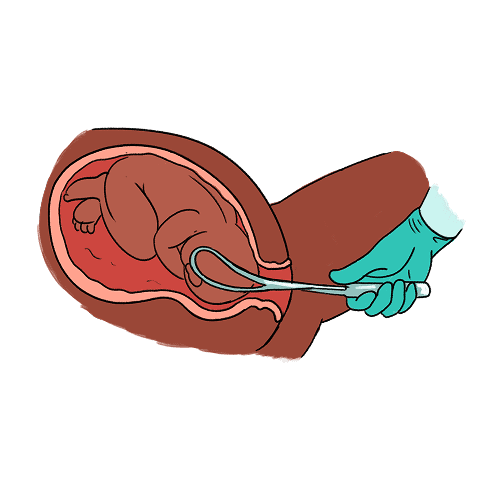 A cross-section illustration of a medical professional using the forceps to hold the baby's head and guide it out of the vagina.