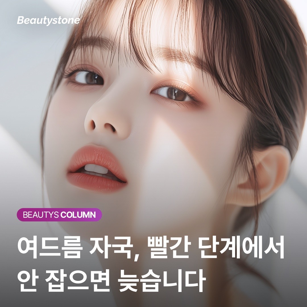 "여드름 자국이 빨갛다면 축하할 일?" 피부가 보내는 회복 신호의 진실