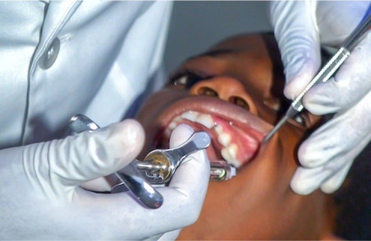 Dental Filling