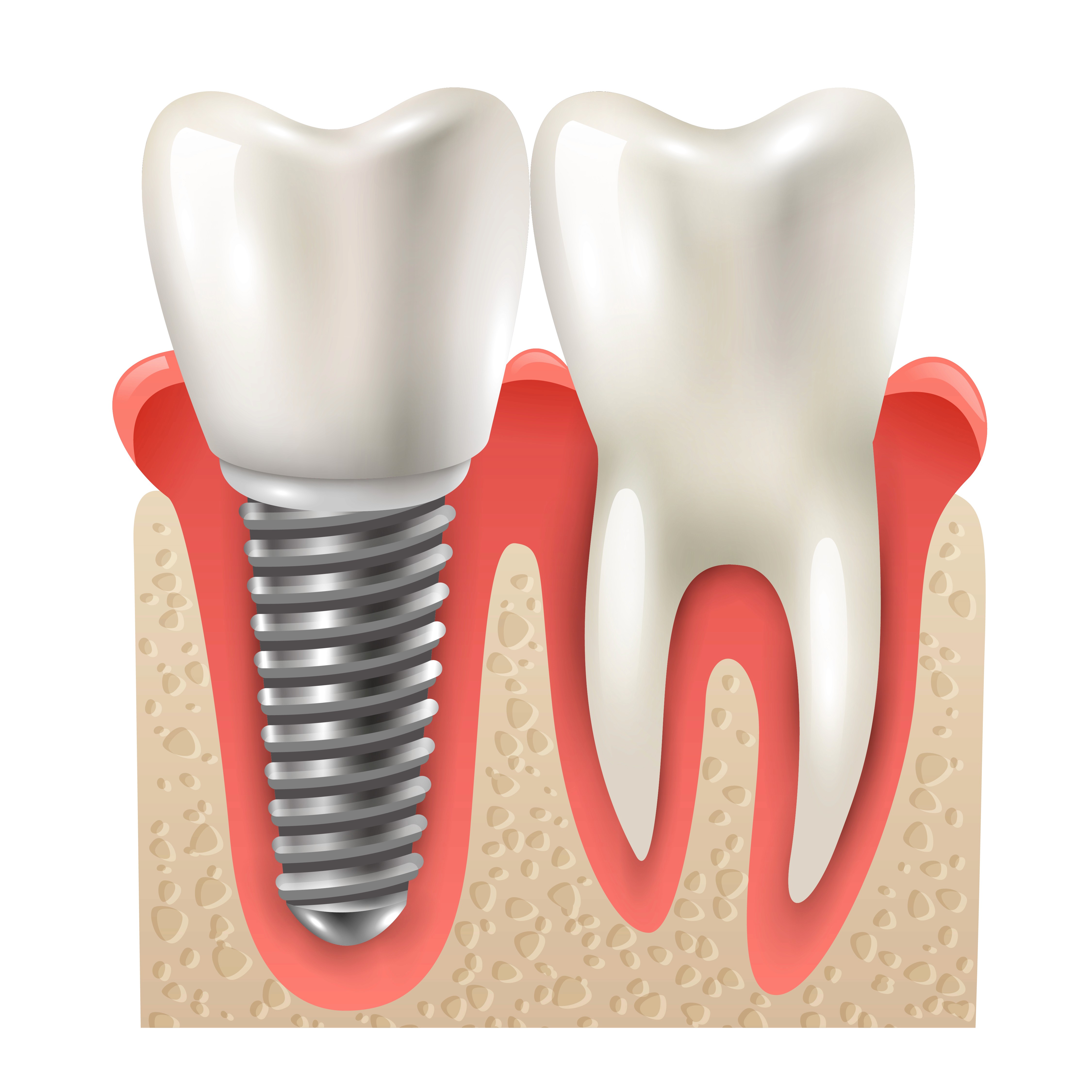 Dental Implants