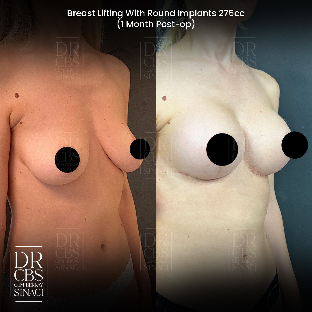 mastopexy-augmentation before after oblique view2