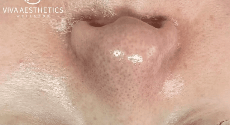 Korean Glow chemical peel treatment before on nose skin.