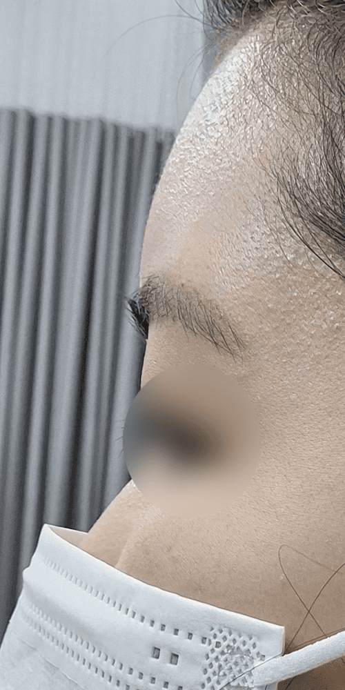 Forehead Filler - After