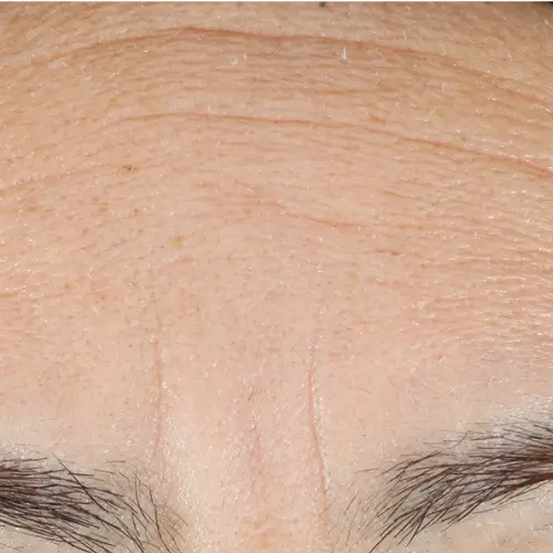 Before peptide therapy at The Vancouver Aesthetician — deep forehead lines and frown wrinkles between brows visibly etched into skin