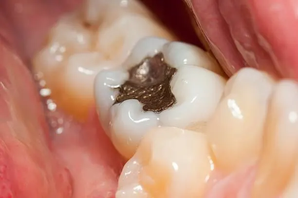 Intraoral Cameras