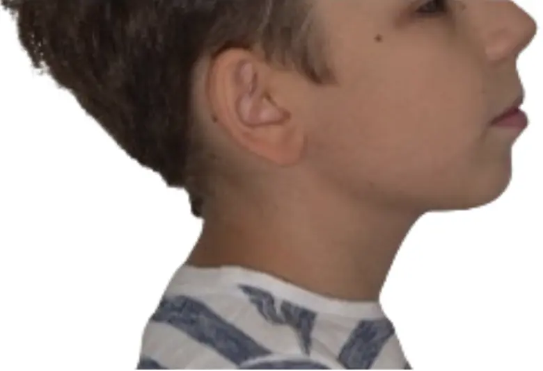 Immediately after the overlays placement
