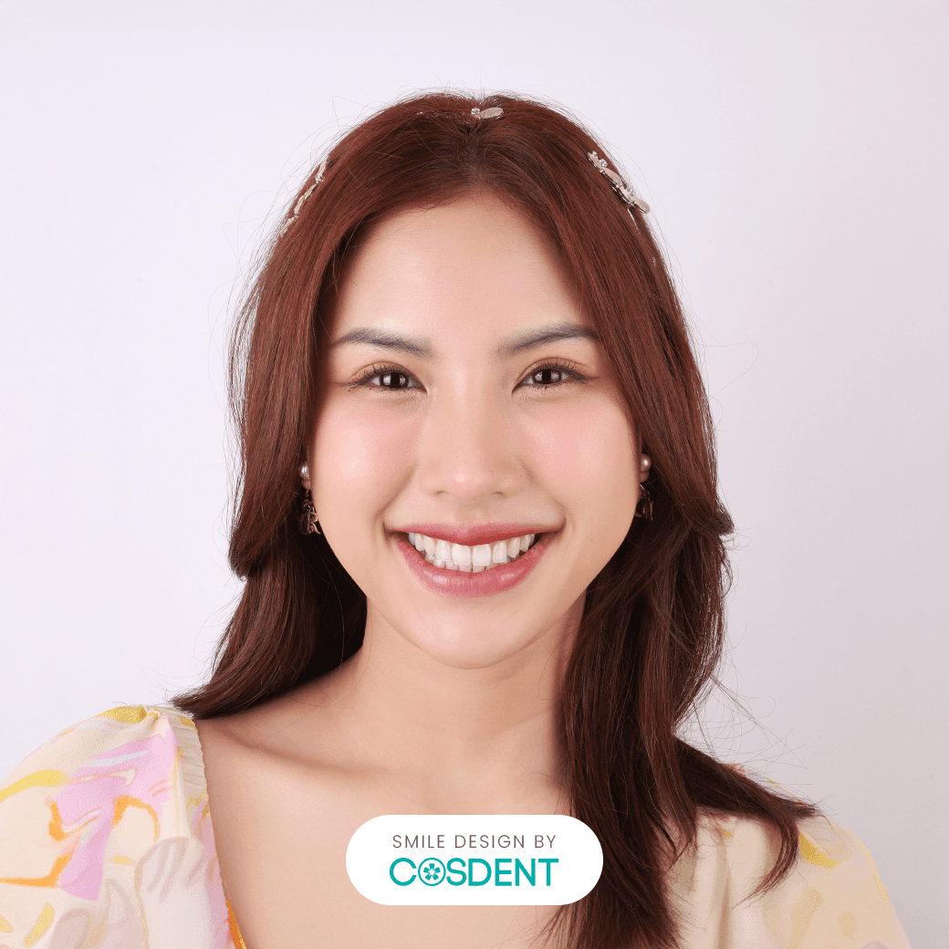 รูปไข่ 20 ซี่ ก่อนทำวีเนียร์