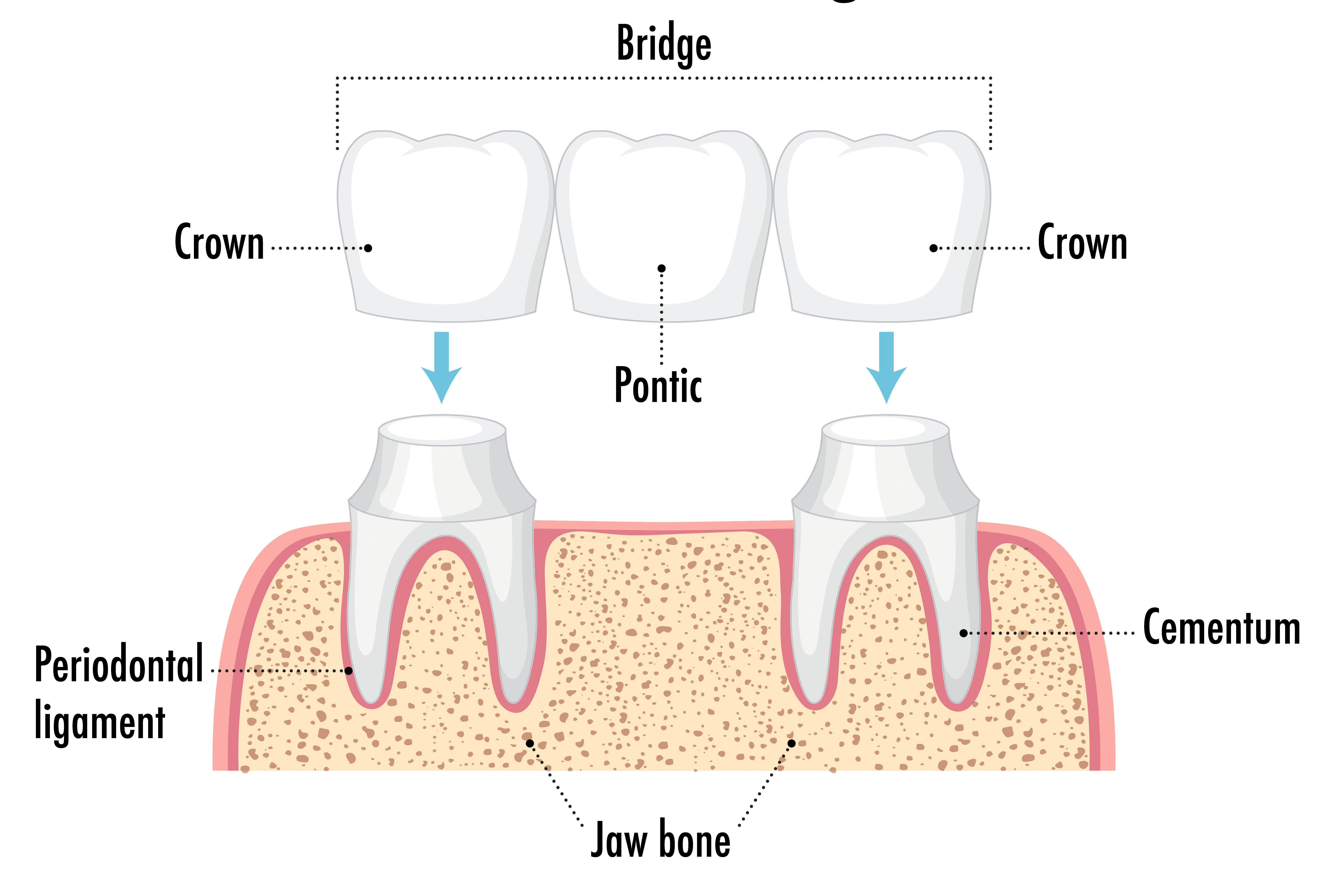 Dental Bridges