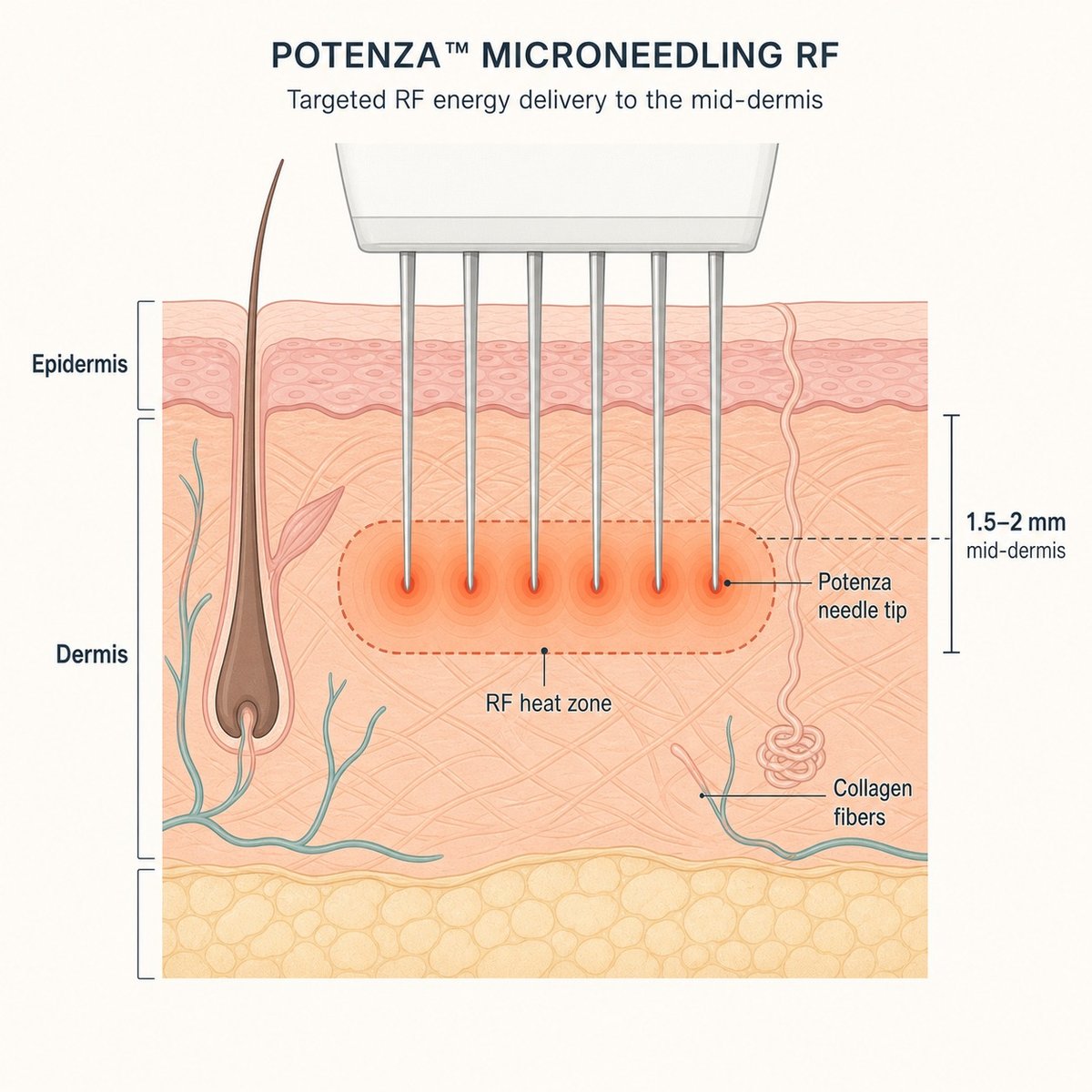 Diagram showing Potenza RF microneedle tip delivering radiofrequency energy into the dermis to stimulate collagen remodeling
