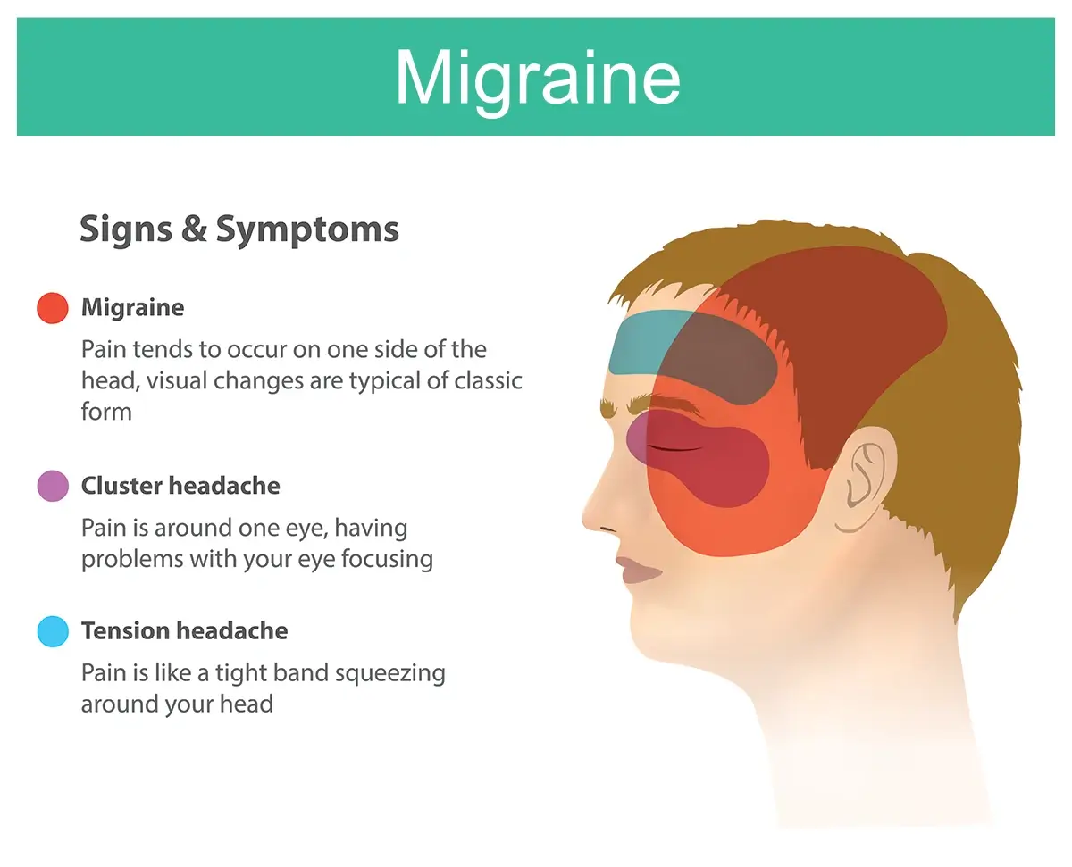 Migraine overview
