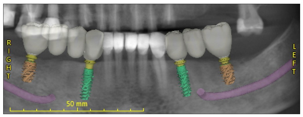 An X-ray image of a dental implant procedure showcasing six apparent teeth with visible titanium posts highlighted in various colors, labeled "RIGHT" and "LEFT" for orientation, with a scale indicating 50 mm at Oakville Dental Implant Studio.