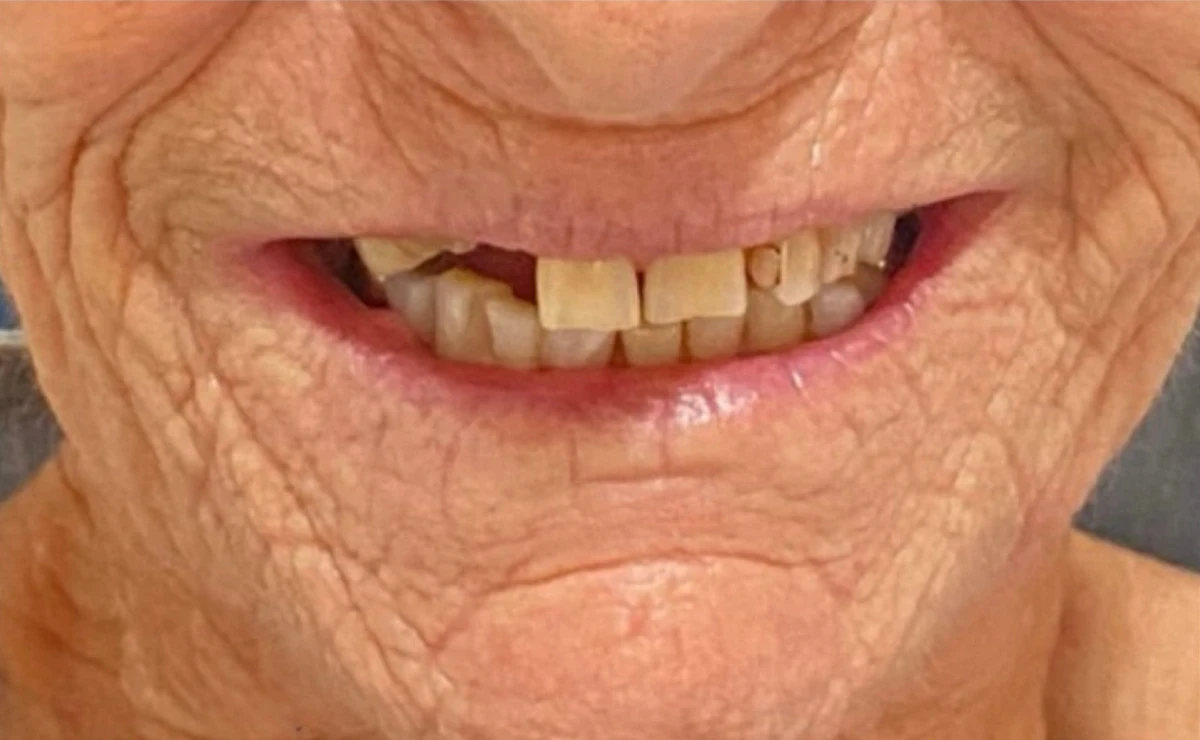 Paciente de Distrito Dental antes de hacerse un implante dental