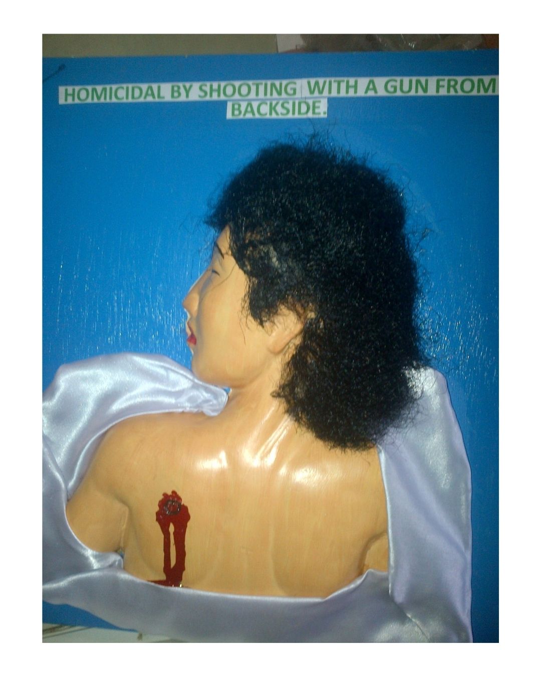 Homicidal Gunshot Wound – Back Entry