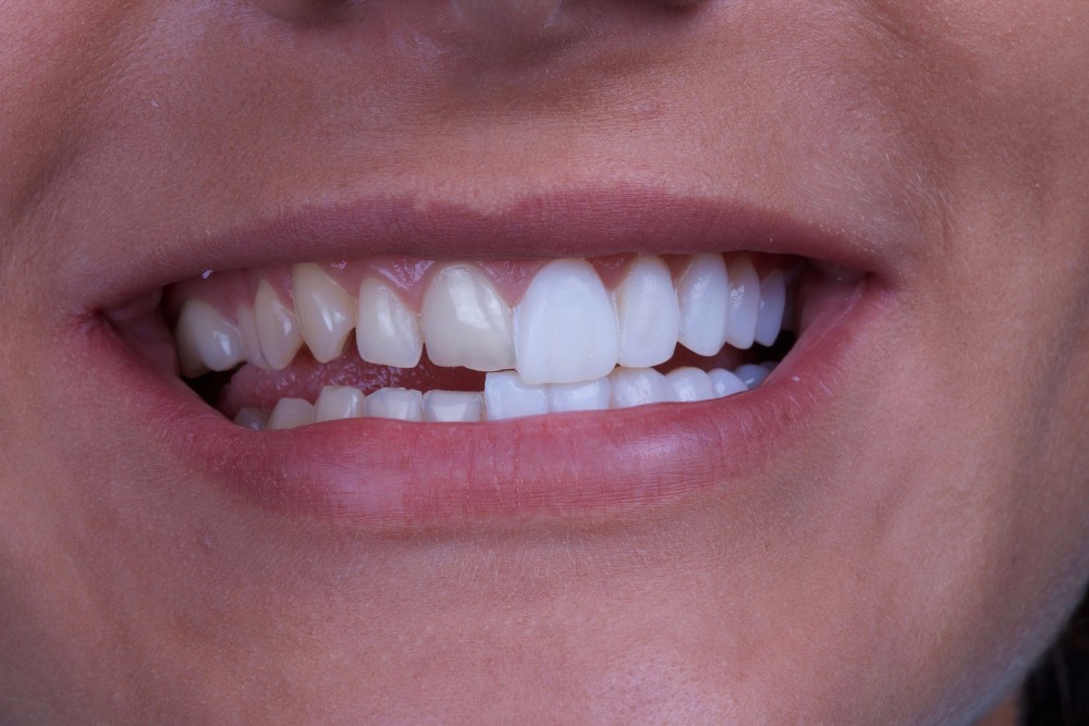 porcelain veneers in Plainview