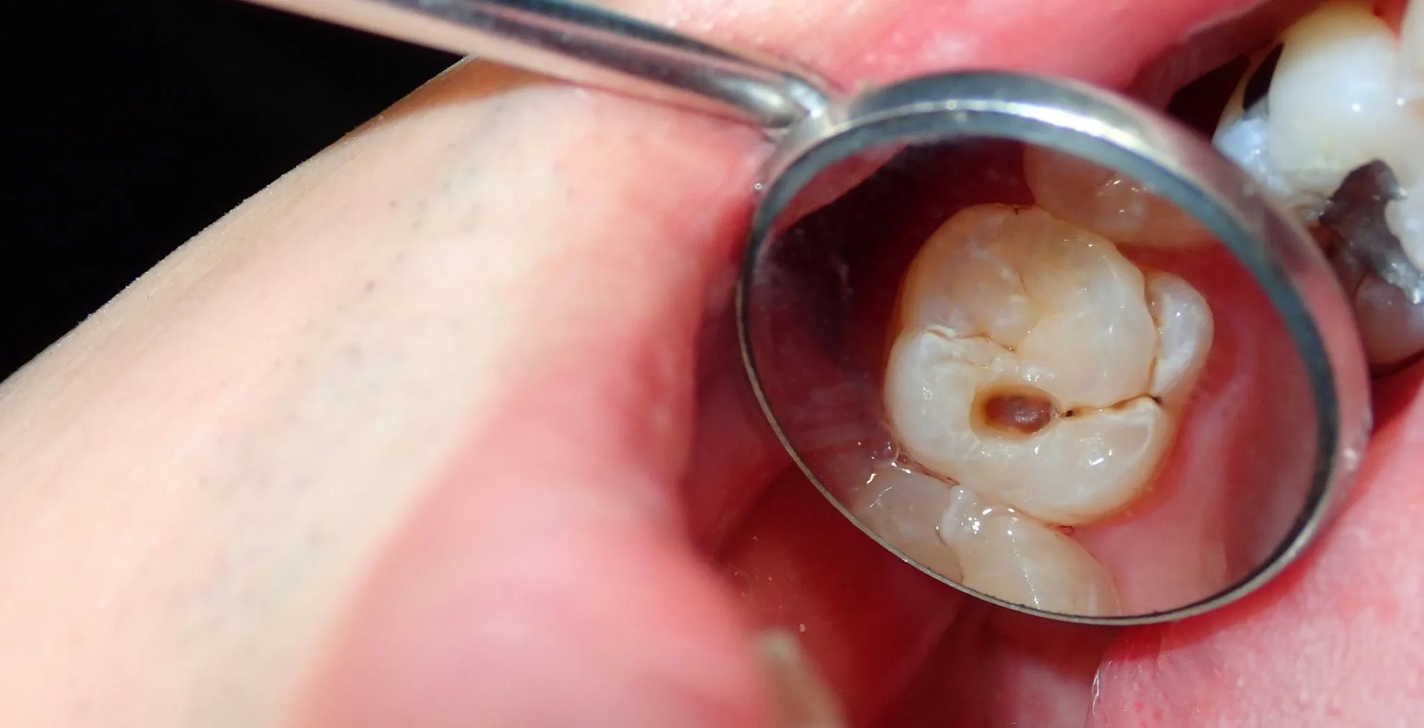 tooth cavity