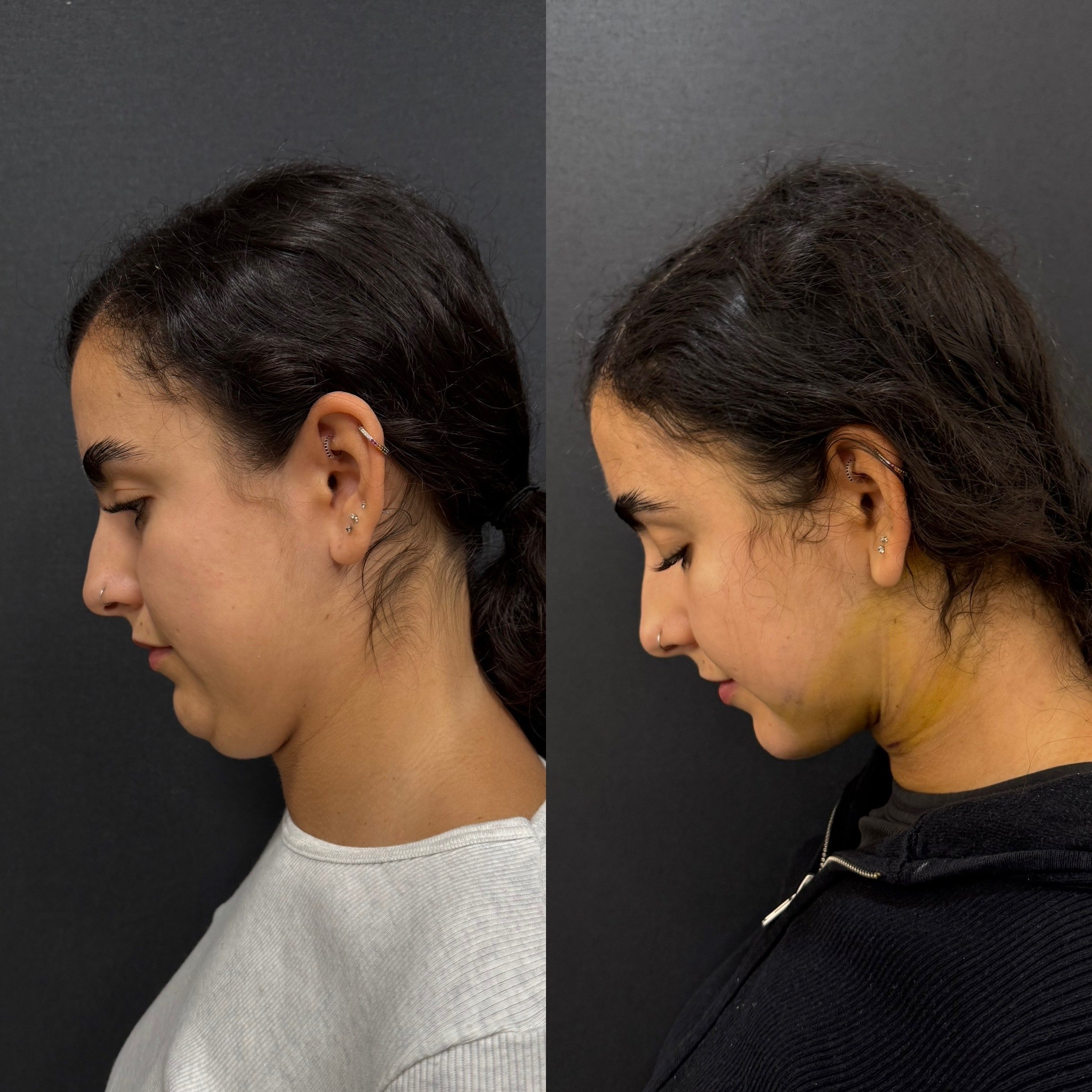 double chin laser liposuction before after 4 days post-op side view