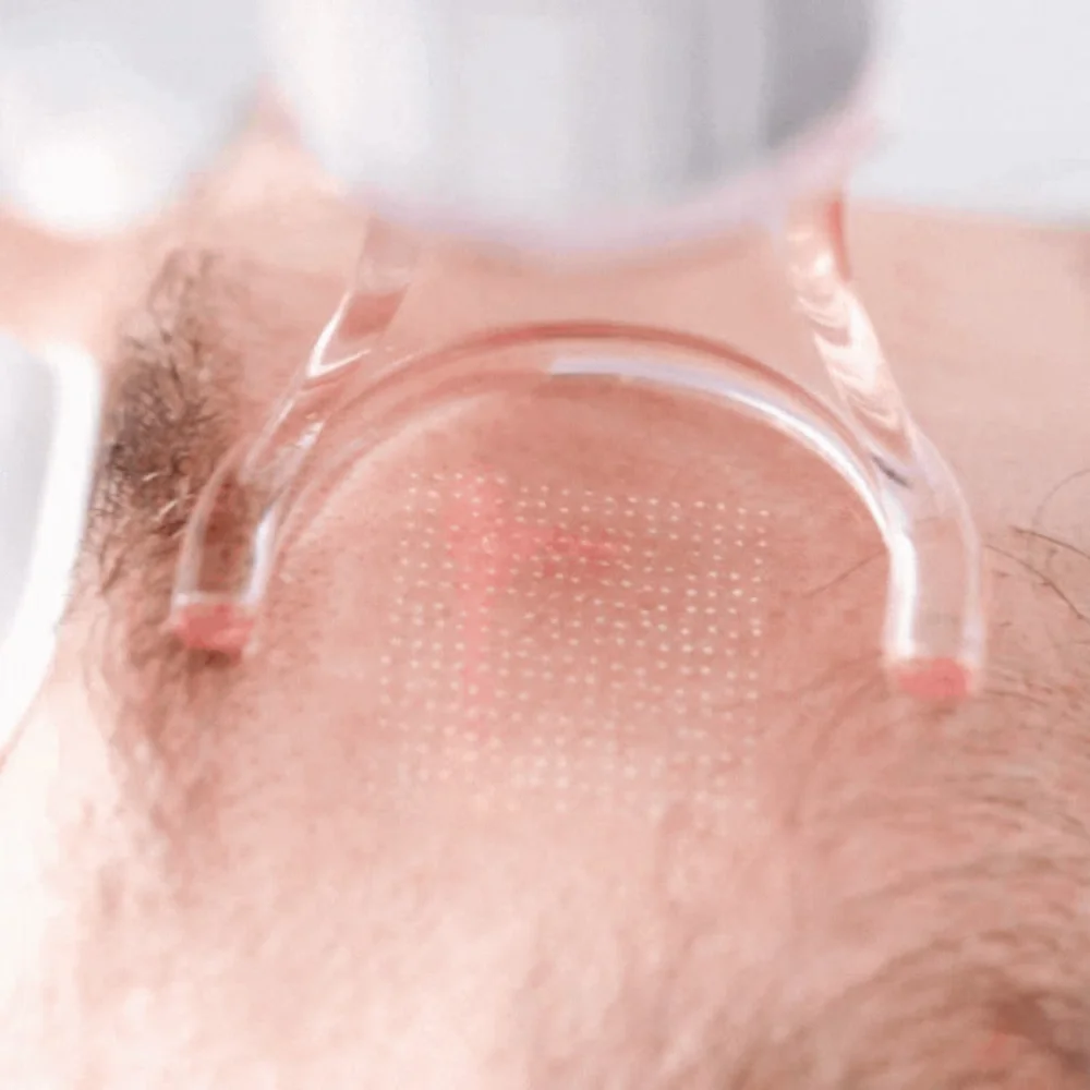 CO₂-Laserbehandlung – Activa Heilbronn