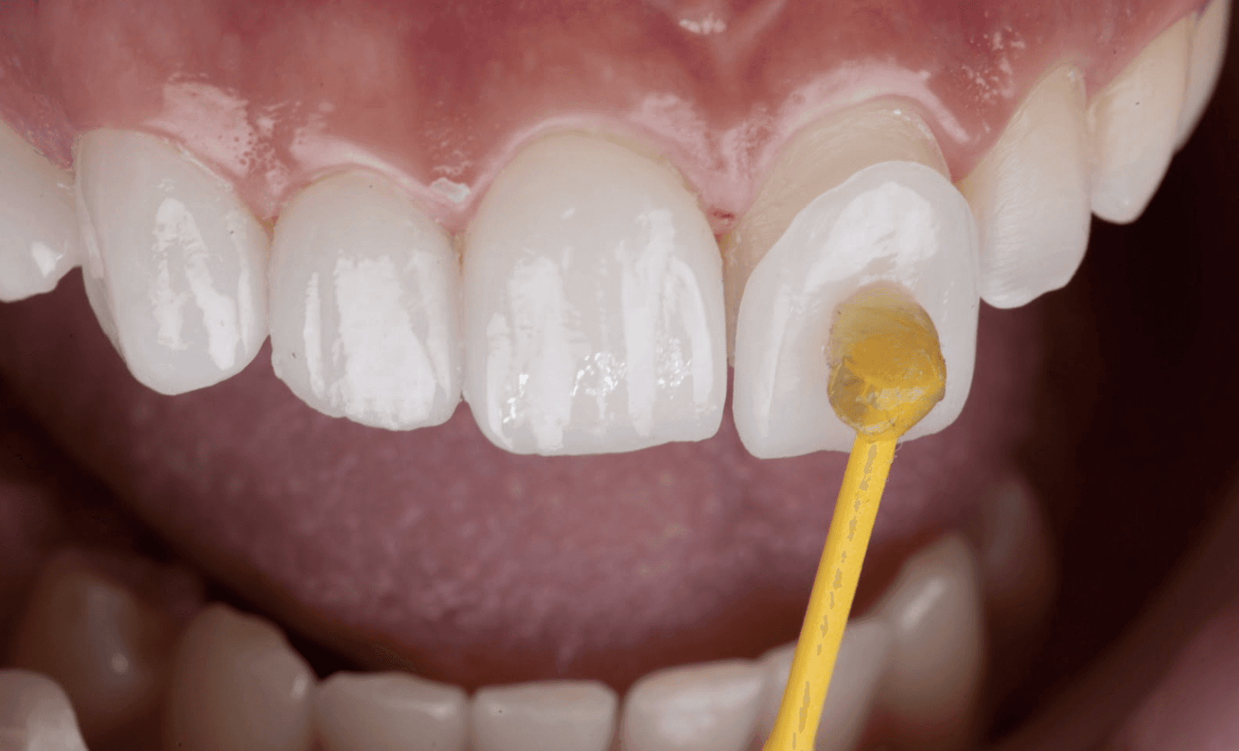 facettedentairesmile