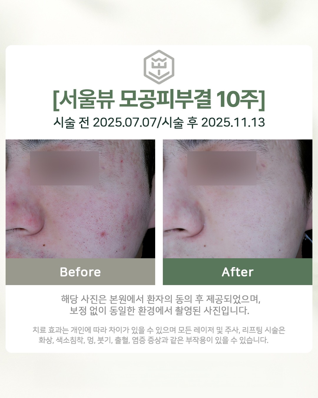 모공피부결 10주